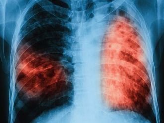 Тенденцията за намаляване на заболеваемостта от туберкулоза е трайна
