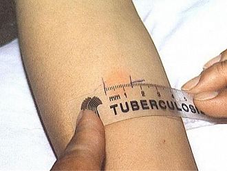  През последните 10 години трайно намалява броят на болните от туберкулоза у нас