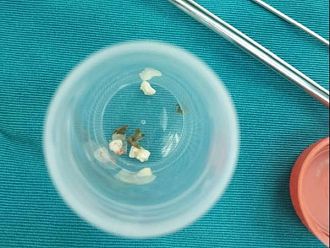 Лекари от УМБАЛ „Св. Марина“ спасиха дете след попадане на чуждо тяло в бронх