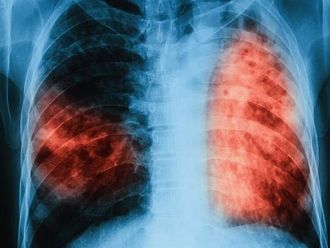 МЗ дава половин милион по програмата за борба с туберкулозата      