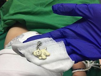 Лекари от МБАЛ-Пазарджик спасиха дете на две години, глътнало ключодържател