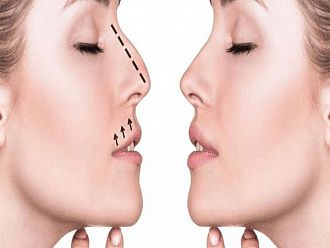 Какво представлява ринопластиката