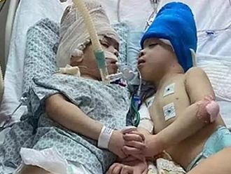 Успешно разделиха сиамски близнаци със слети мозъци чрез виртуална реалност