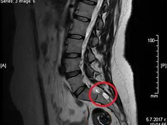 Тарловите пациенти искат промени в 4 клинични пътеки или нова пътека за заболяването им