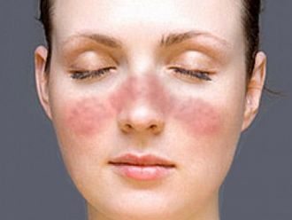 Средно шест години отнема диагностицирането на лупус