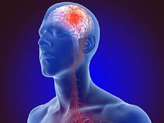 Свързаните с инсулт смъртни случаи от мозъчно кървене ще се увеличат с 8,9% до 2050 г.