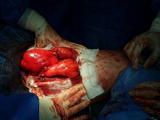 Трикилограмов тумор извадиха лекари от бедрото на мъж