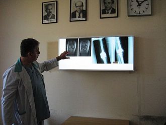 Индивидуално изработена ендопротеза замени част от бедрената кост на онкоболна пациентка