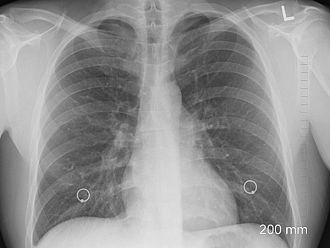 Скрининг за рак на белия дроб правят в столичен мол