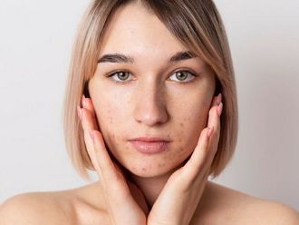 А дерма и акне - пътуване към по-чиста кожа