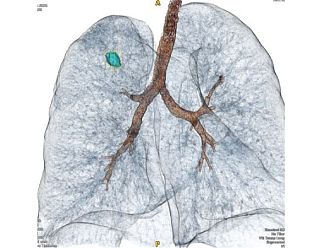 Сложна микроинвазивна процедура извършиха екипи на УМБАЛ „Канев“