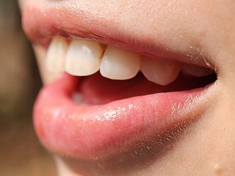 5 признака, че са ви необходими алайнери