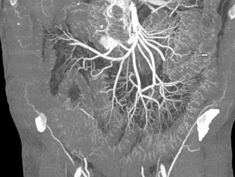 PRAC препоръча прекратяване разрешенията за употреба на линеарни гадолиний-съдържащи контрастни вещества