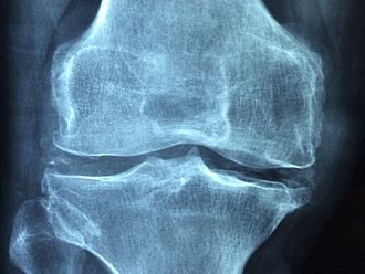 Над 420 хил. българи страдат от остеопороза