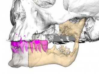 Уникално за Югоизточна Европа трансплантиране на челюст извършиха в „Пирогов“