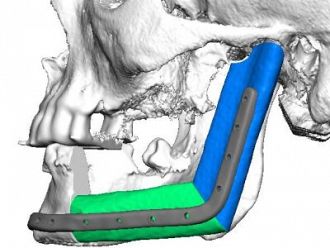 Уникално за Югоизточна Европа трансплантиране на челюст извършиха в „Пирогов“