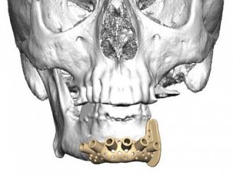 Уникално за Югоизточна Европа трансплантиране на челюст извършиха в „Пирогов“