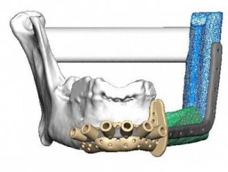 Уникално за Югоизточна Европа трансплантиране на челюст извършиха в „Пирогов“