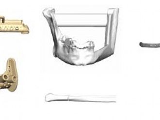 Уникално за Югоизточна Европа трансплантиране на челюст извършиха в „Пирогов“