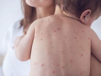 Шест държави от Европейския регион на СЗО губят статута си на свободни от морбили