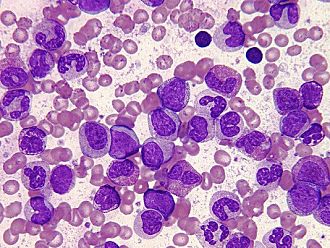 520 българи се борят с хронична миелоидна левкемия