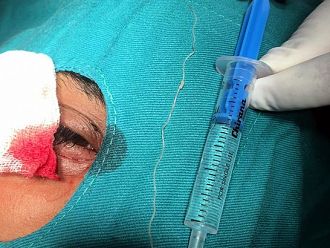 Три дни вадят 10-сантиметров паразит от окото на пациент в Плевен
