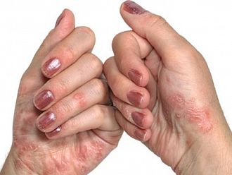 Над 20 болници в страната участват в кампанията „Какво става под кожата ви?“ 