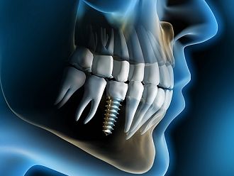В УМБАЛ „Св. Анна“ започва цялостно имплантологично лечение