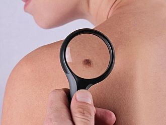 Безплатни прегледи за рак на кожата в УСБАЛО