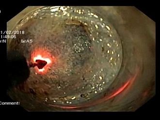 За първи път в България беше извършена манипулация за преодоляване на ахалазия