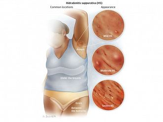 Отбелязваме Седмицата за информираност за гноен хидраденит