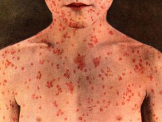 Бум на дребна шарка в Европа заради намалено ваксинално покритие