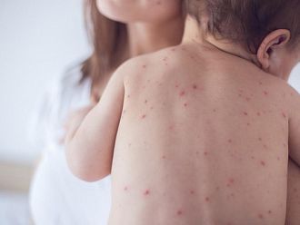 В Пловдив издирват деца без ваксинация срещу морбили