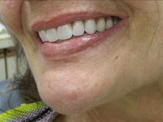 Заплащането на цели плакови протези за възрастни с обществени средства вече е факт