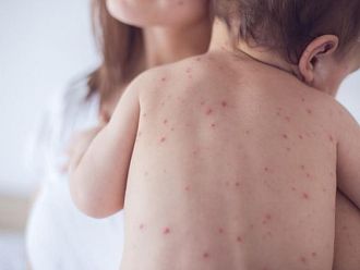 Полското правителство призова за масови ваксинации срещу морбили