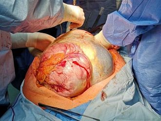 Извадиха 18-килограмов тумор от корема на жена