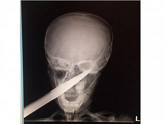 Спасиха дете със забита в главата градинска ножица в УМБАЛ-Бургас