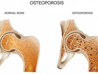 Над 400 000 са диагностицирани с остеопороза у нас, още толкова са в риск