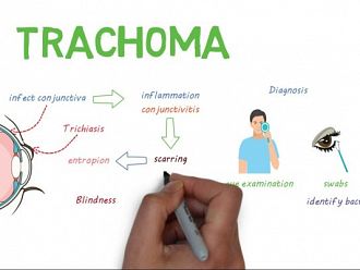 С 91% са намалели хората, изложени на риск от трахома